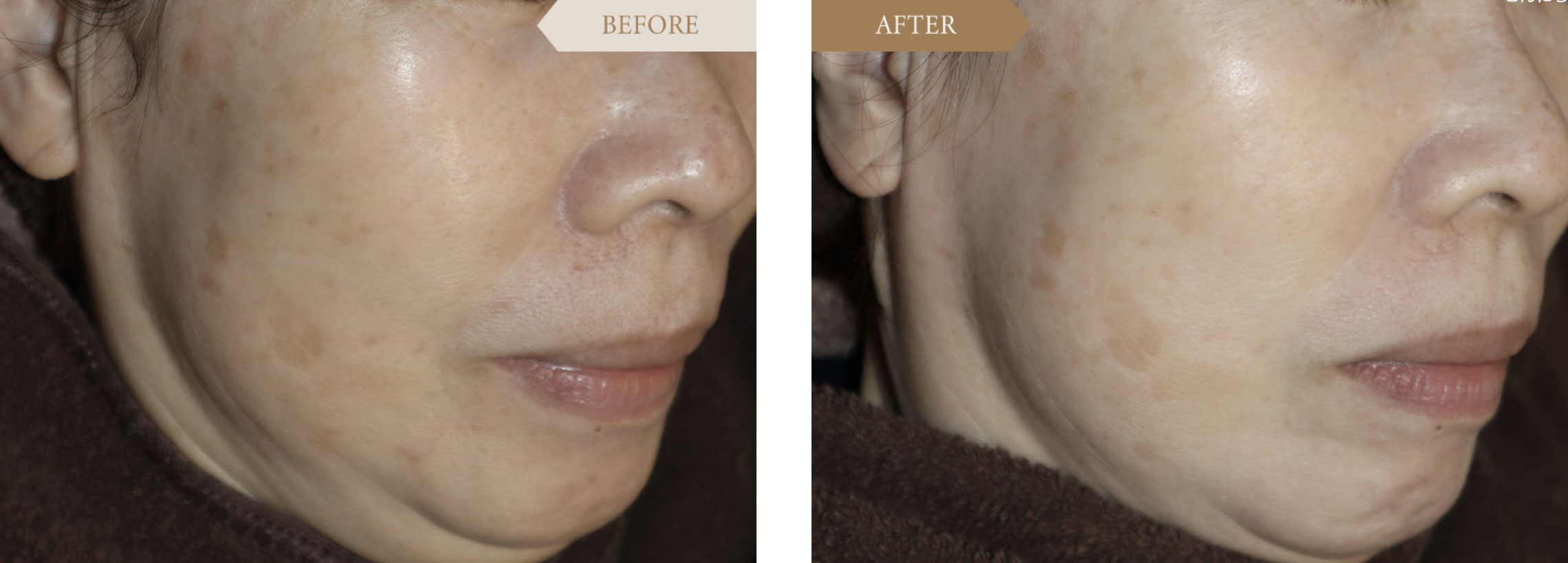 女性症例 マッサージピールビフォアアフター1