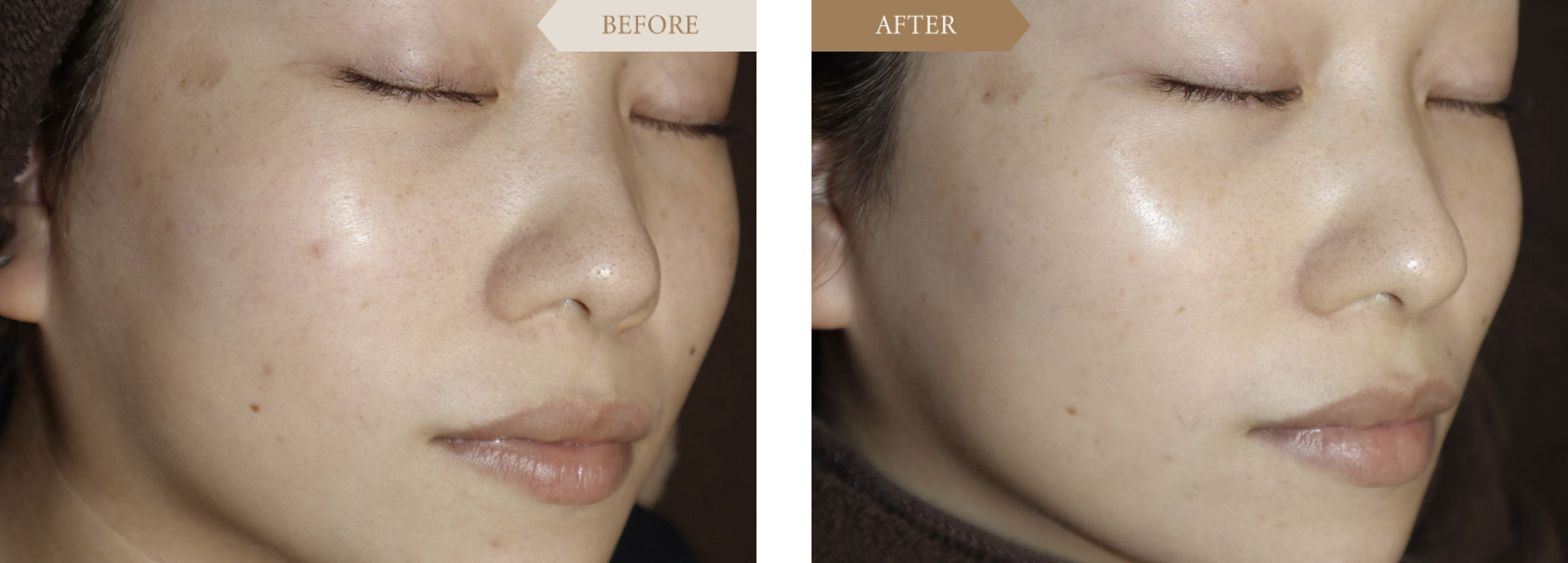 女性症例 マッサージピールビフォアアフター2