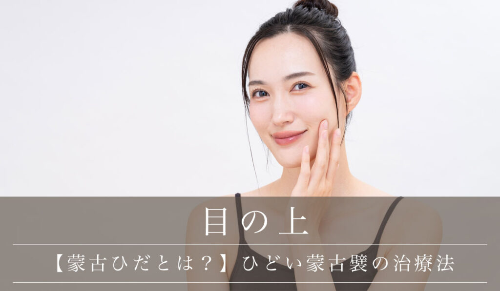 【蒙古ひだ（もうこひだ）とは？】ひどい蒙古襞を自力でなくすデメリットと治療法