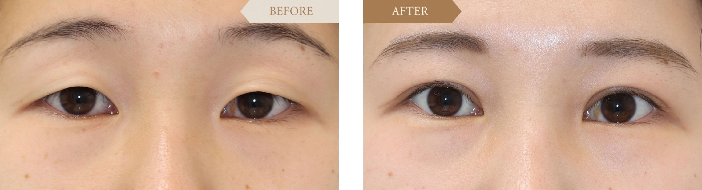 一重から二重の施術事例ビフォアアフター1