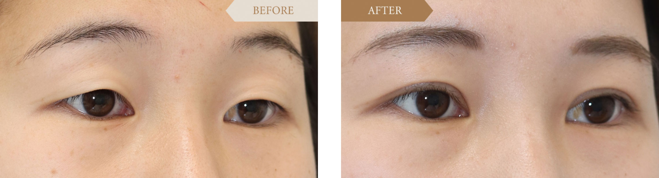 一重から二重の施術事例ビフォアアフター2