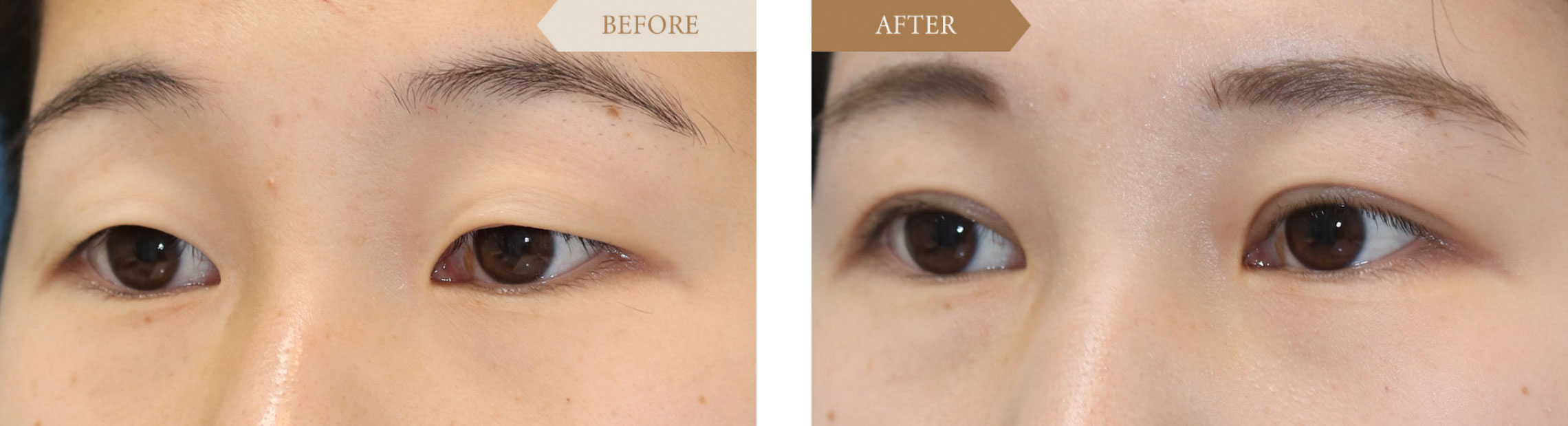 一重から二重の施術事例ビフォアアフター3