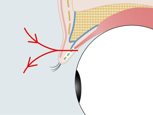 二重埋没法イメージイラスト