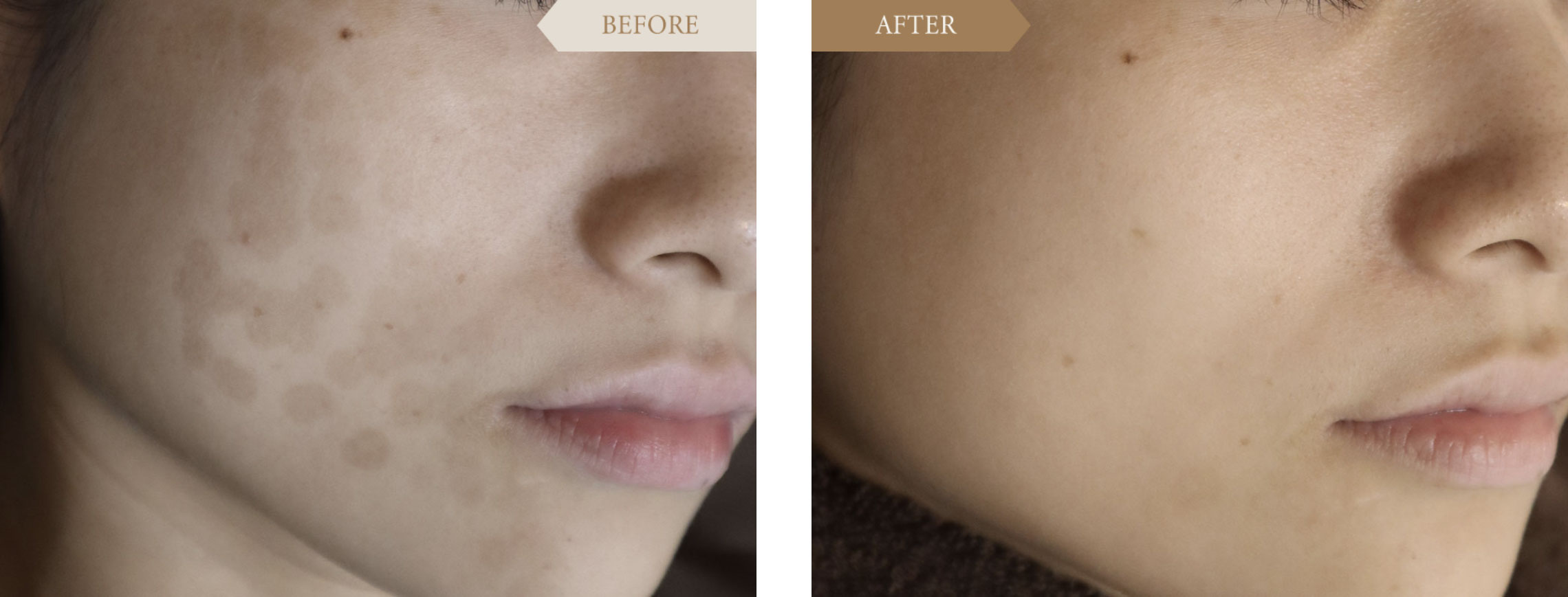 トーニングによるシミ取り・シミ消しビフォアアフター1