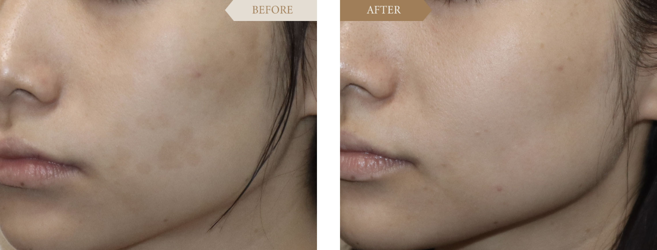 トーニングによるシミ取り・シミ消しビフォアアフター2