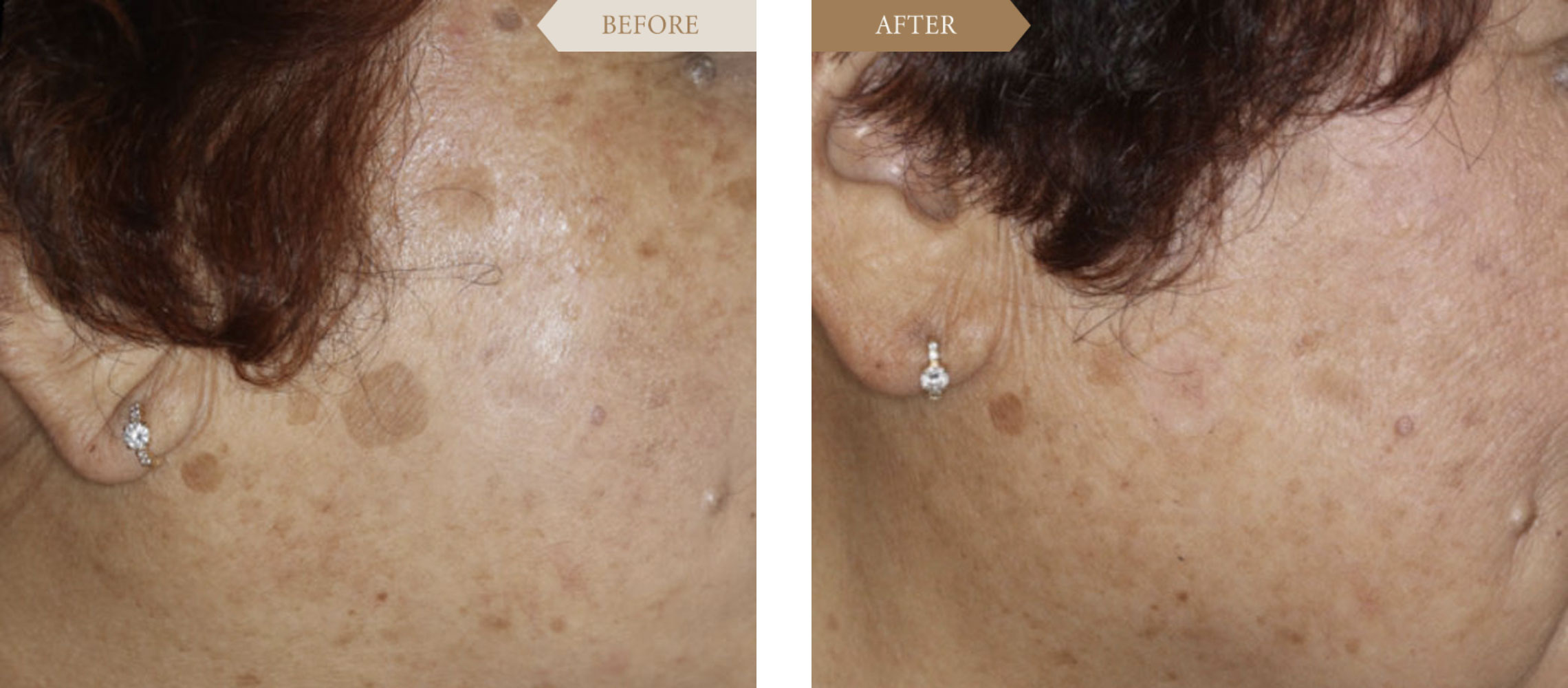 Qスイッチヤグレーザーで顔のシミ取り