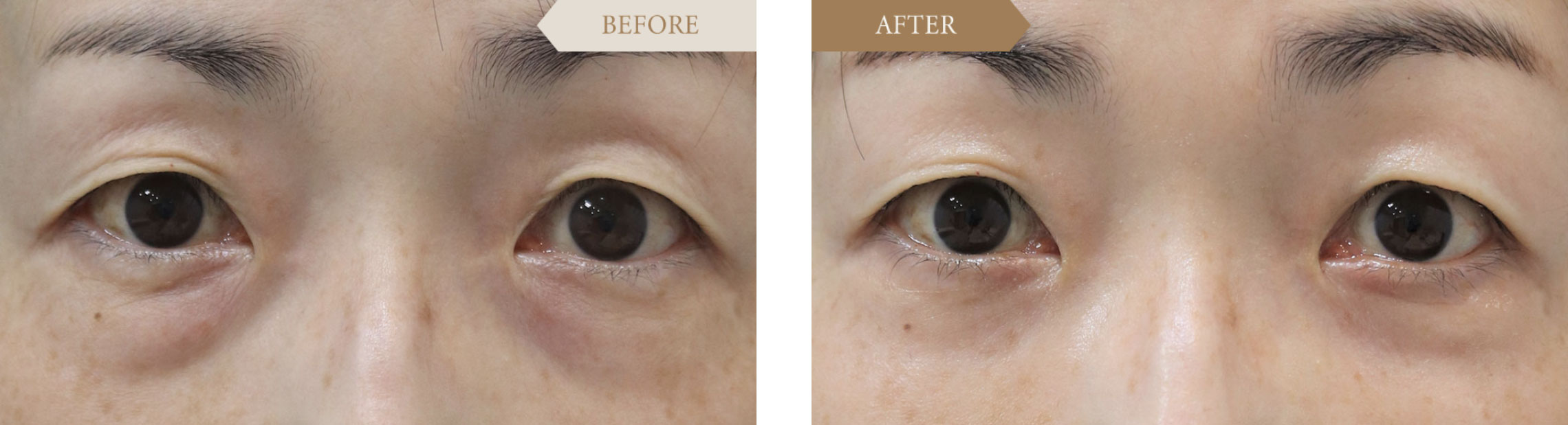 裏ハムラ法ビフォアアフター1