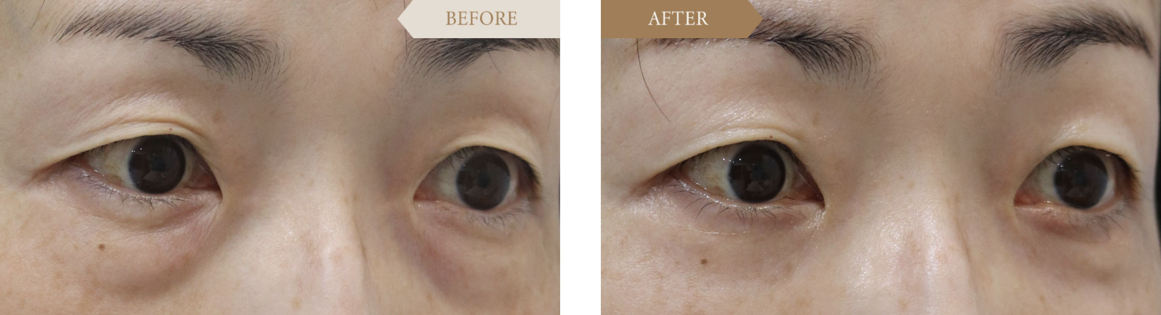 裏ハムラ法ビフォアアフター2