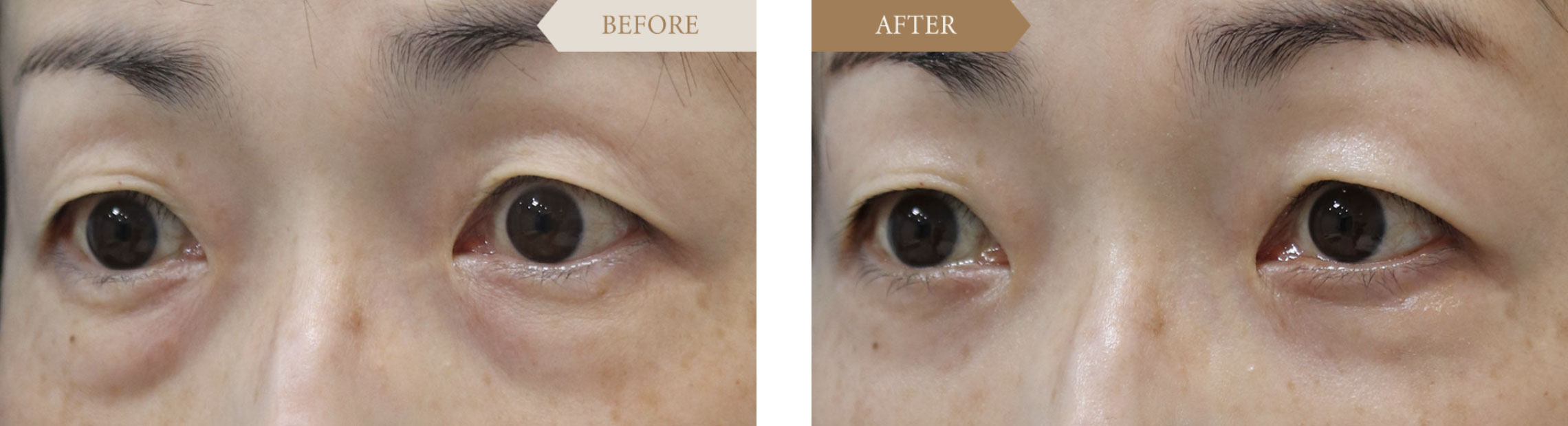 裏ハムラ法ビフォアアフター3