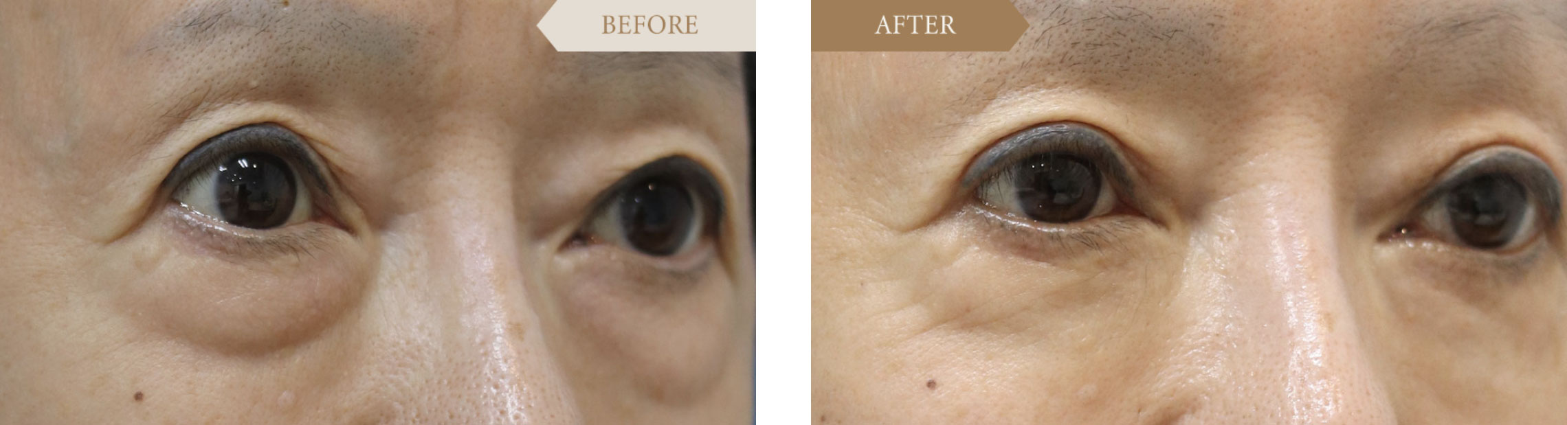 他院修正　裏ハムラで改善ビフォアアフター2