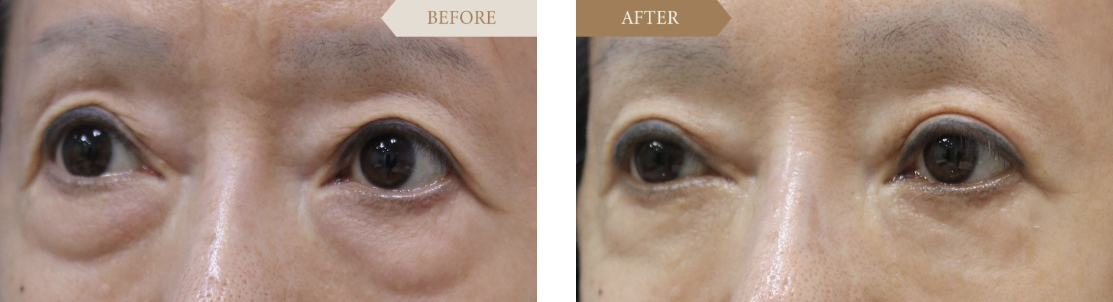 他院修正　裏ハムラで改善ビフォアアフター3