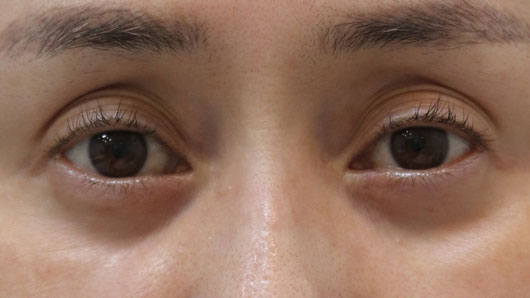 脱脂後の凹みの例