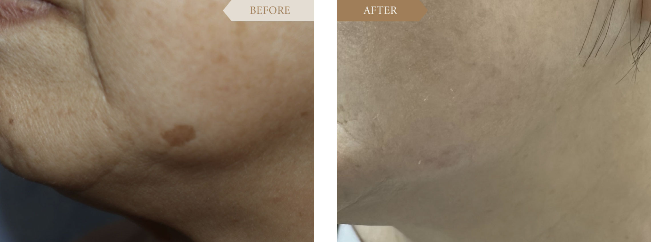 女性のあごのシミへのレーザー治療ビフォアアフター