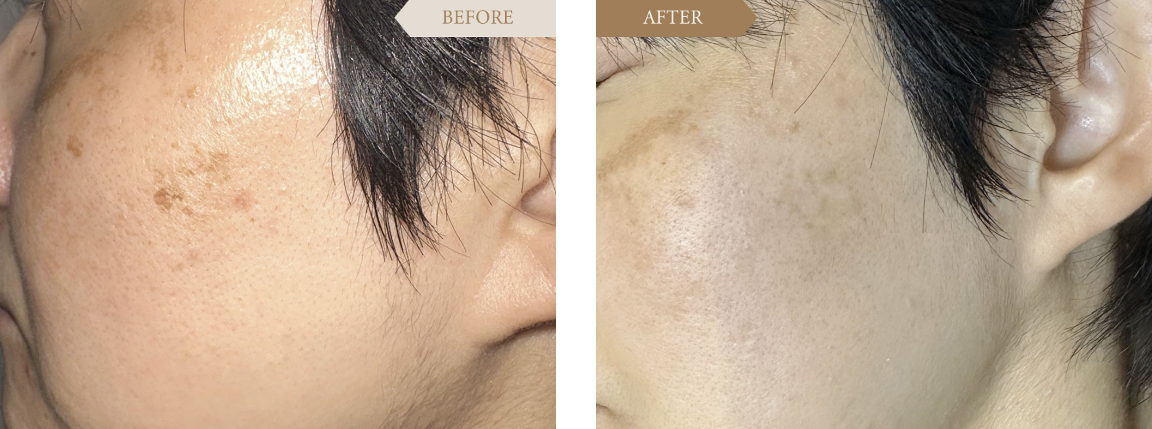 男性の顔のシミへのレーザー治療ビフォアアフター