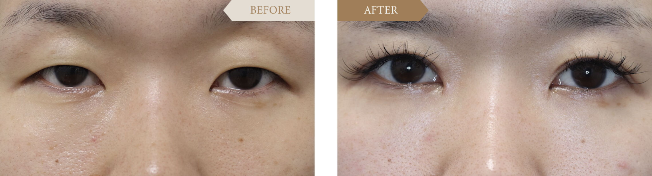 目頭切開ビフォアアフター1