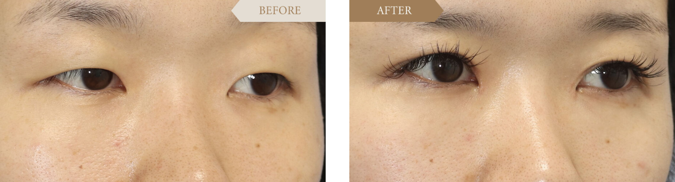 目頭切開ビフォアアフター2