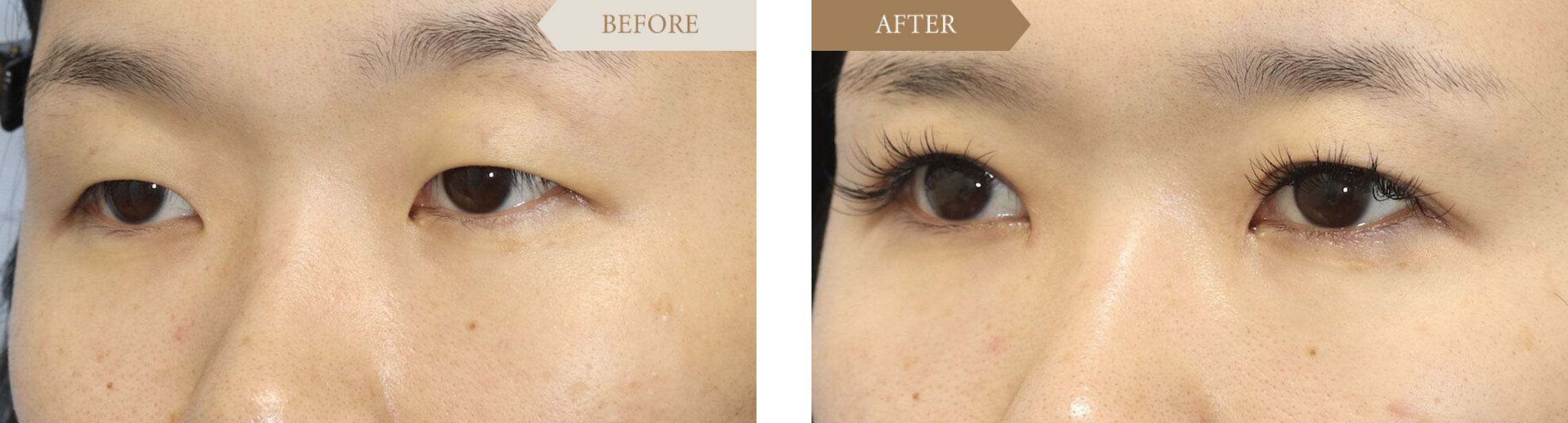 目頭切開ビフォアアフター3