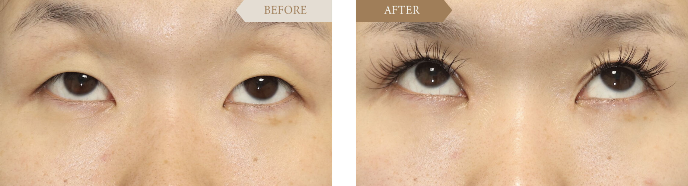 目頭切開ビフォアアフター4