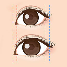 目頭切開のイメージイラスト