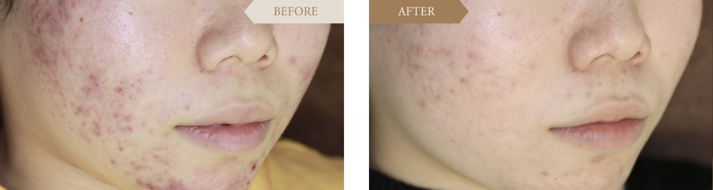 女性 ニキビ跡治療ビフォアアフター