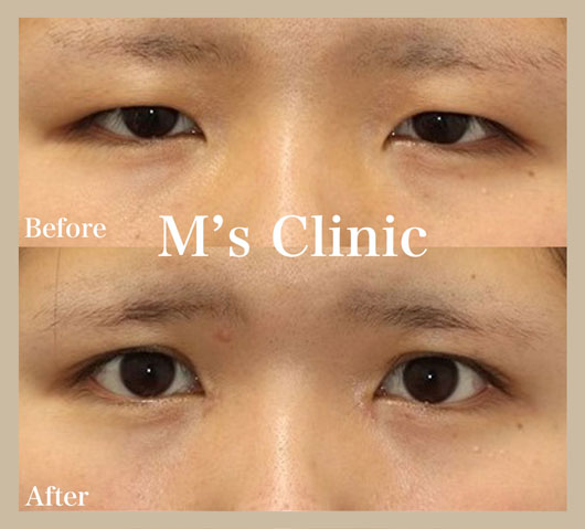 二重全切開と目頭切開の組み合わせ施術ビフォアアフター