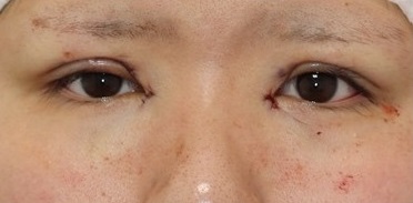 二重全切開と目頭切開の組み合わせ施術直後