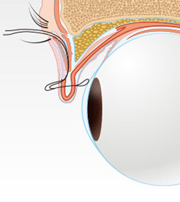 切らない眼瞼下垂手術イメージイラスト