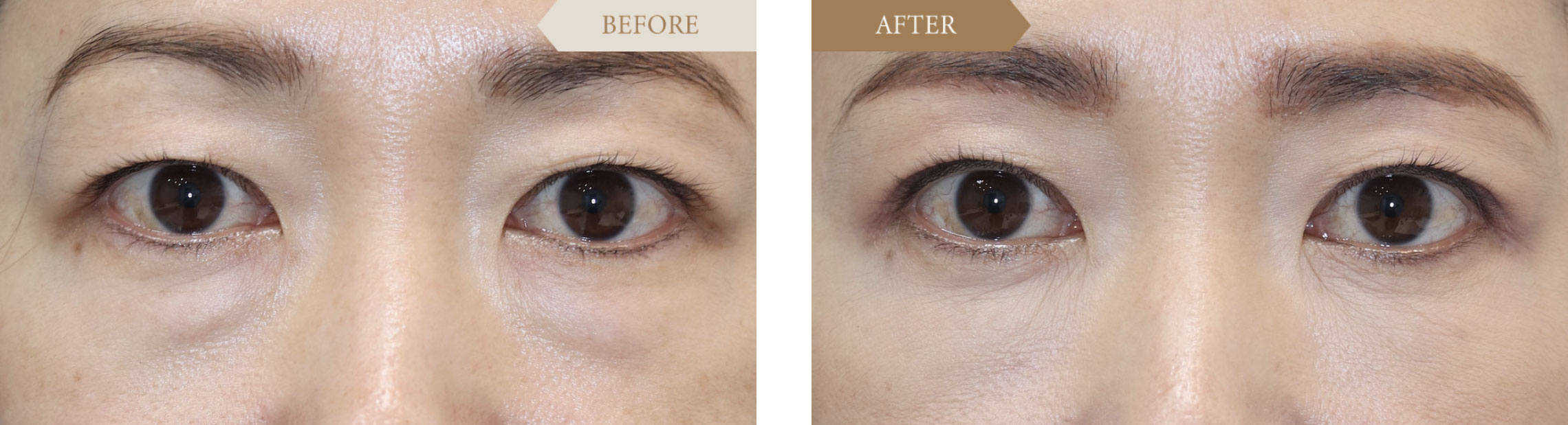 40代女性 眉下切開事例1