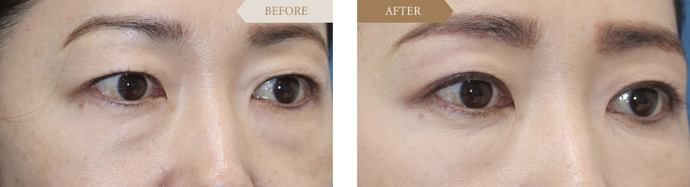 40代女性 眉下切開事例2