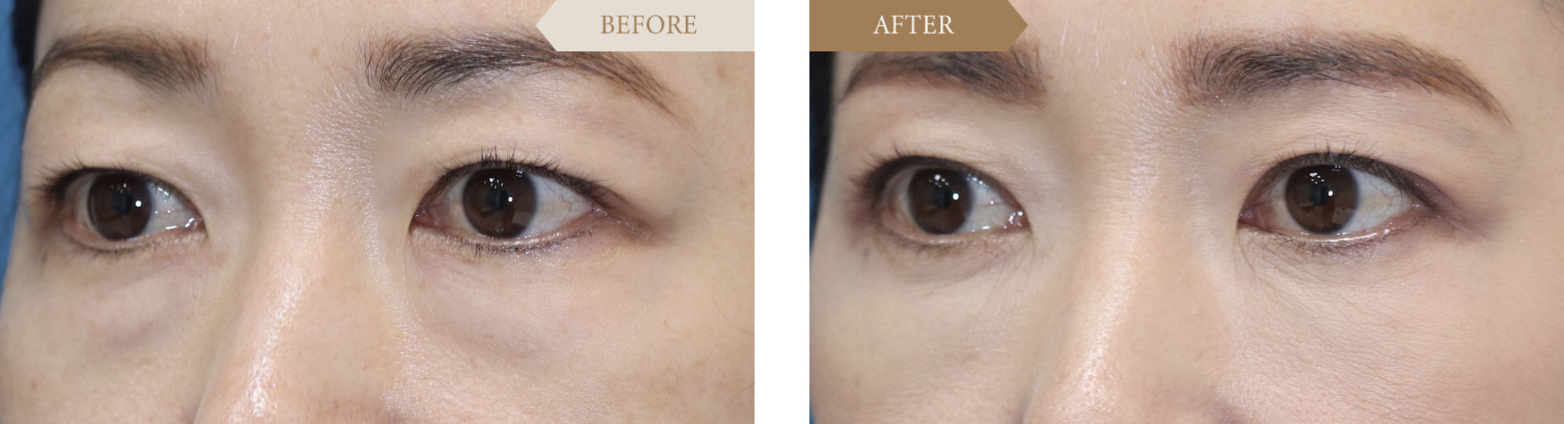 40代女性 眉下切開事例3