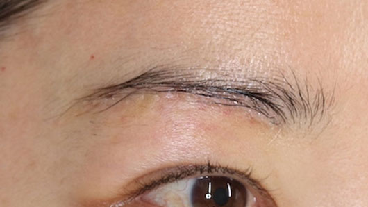 術後1週間の経過