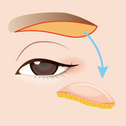 眉下切開の手術イメージイラスト