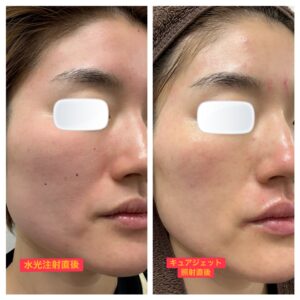 水光注射とキュアジェット✨ダウンタイムの違い‼︎