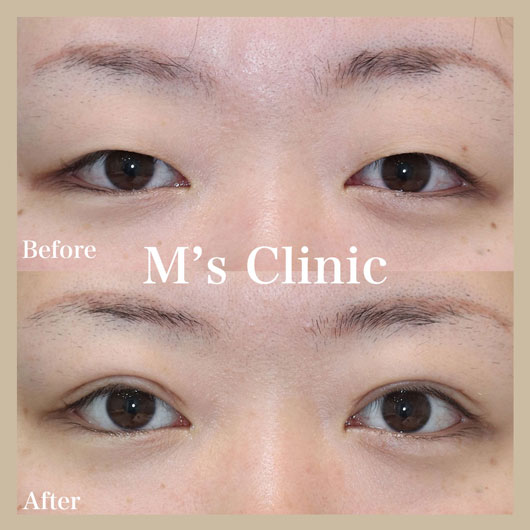 一重から二重へのビフォアアフター症例