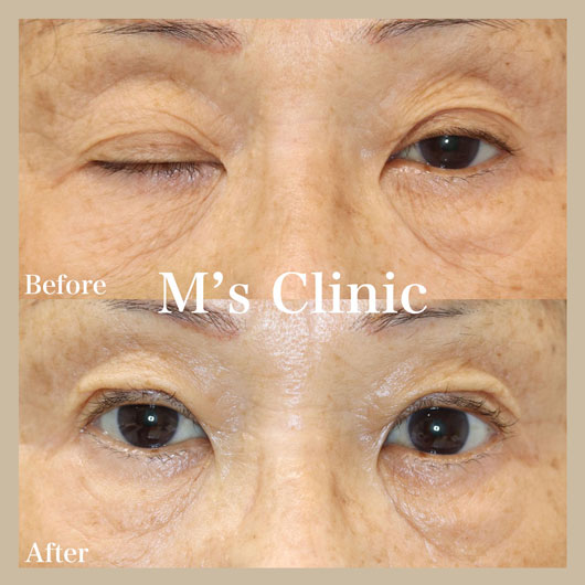 高齢者の重度眼瞼下垂症ビフォアアフター