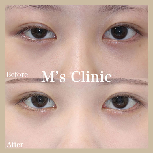 片目の眼瞼下垂症例