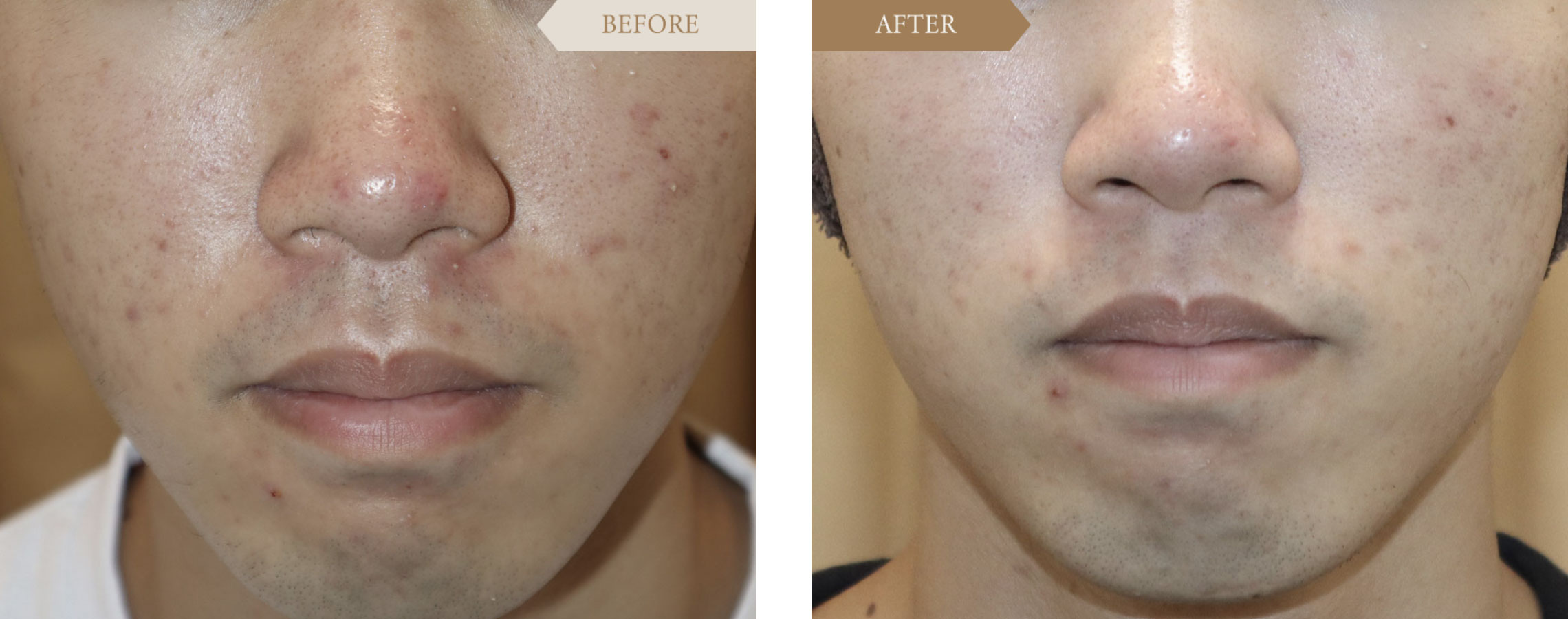 Mixピールの施術事例 ほお