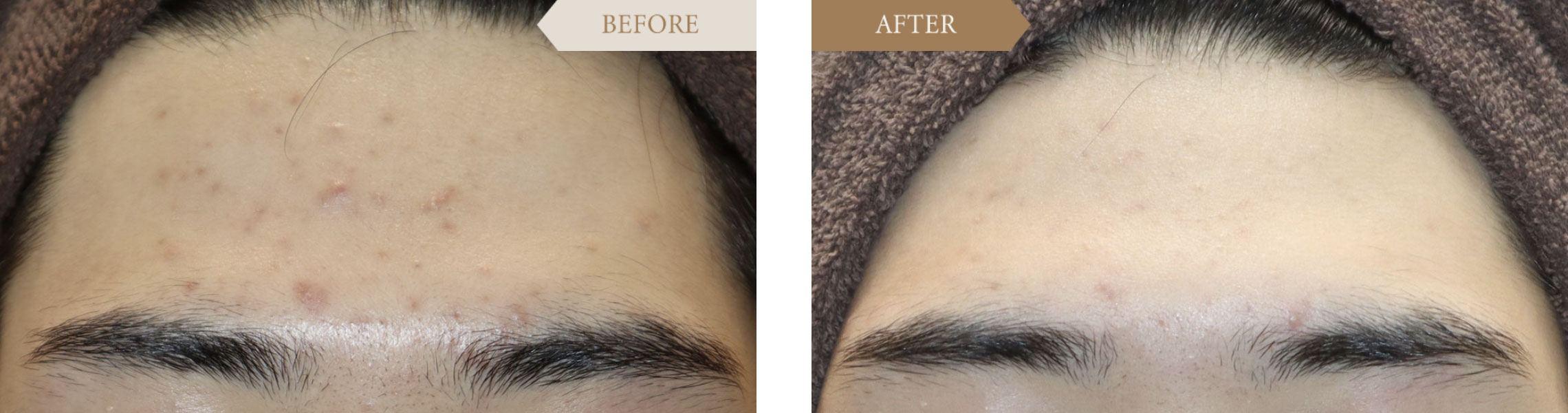 Mixピールの施術事例 おでこ