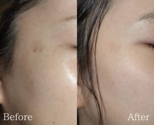 Qスイッチレーザー×フォトフェイシャルで、より綺麗なシミ改善を✨