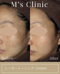 繰り返すシミ…それ、肝斑かもしれません😱😱