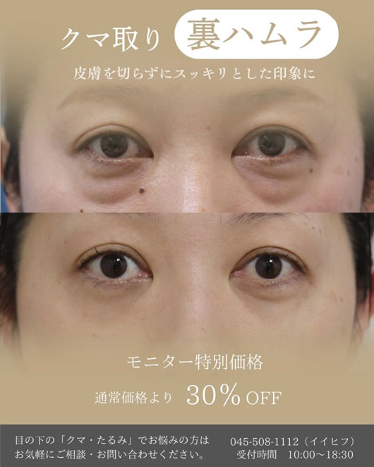 裏ハムラ法キャンペーン