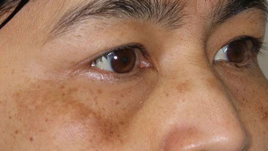 目の下の色素沈着