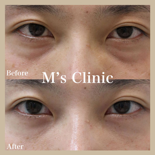 20代男性の目の下のクマ治療ビフォアアフター