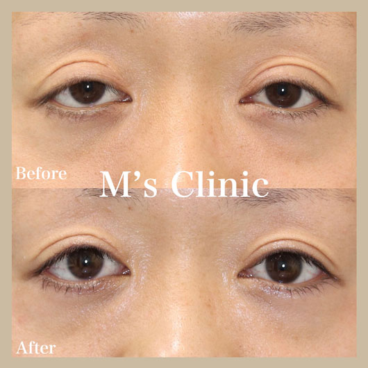 眼瞼下垂の他院修正の症例写真