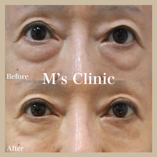 目の下のたるみ女性ビフォアアフター事例
