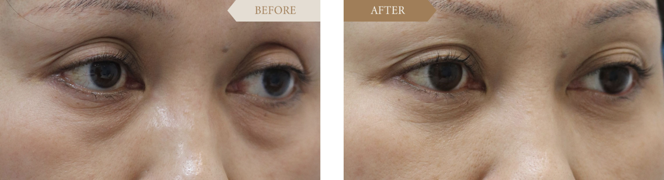 40代／女性 裏ハムラ法のビフォアアフター2