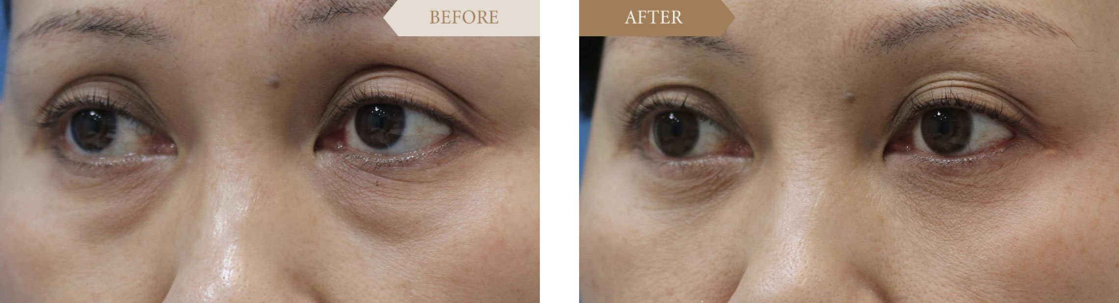 40代／女性 裏ハムラ法のビフォアアフター3