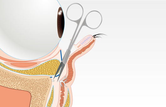 ティアトラフ靭帯の剥離イラスト
