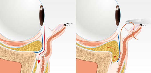 裏ハムラ法による靭帯解除と眼窩脂肪移動のイラスト