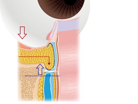 眼窩隔膜前スペースに押し出された眼窩脂肪
